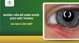 Sưng khóe mắt
