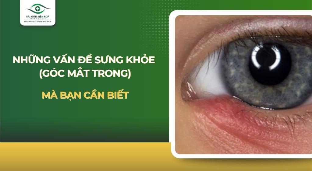 Sưng khóe mắt