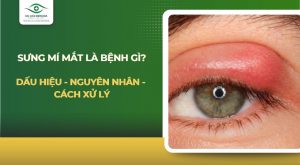 sưng mí mắt