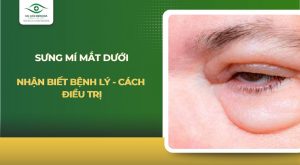 sưng mí mắt dưới
