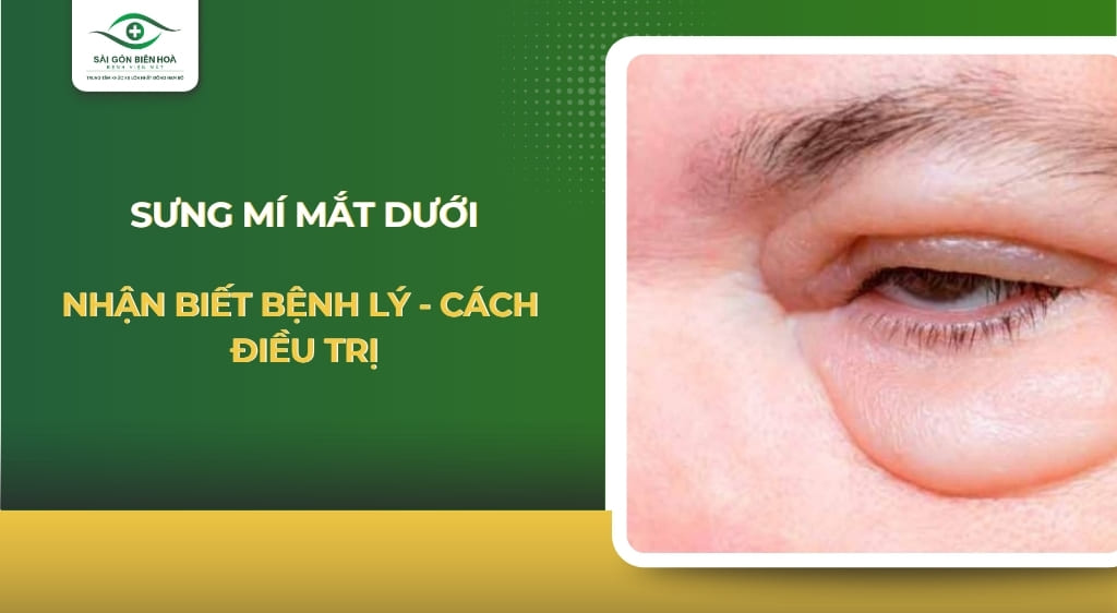 sưng mí mắt dưới