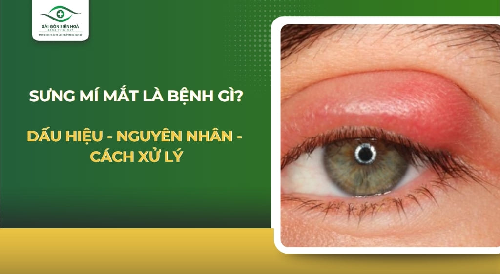 sưng mí mắt