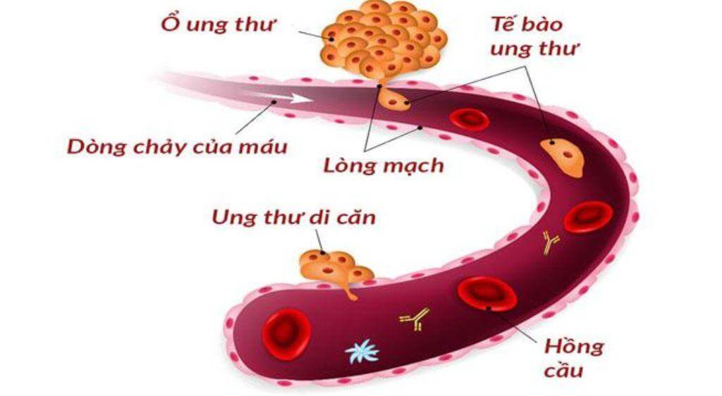 Tế bào ung thư từ cơ quan khác sẽ di căn theo đường máu để đi đến hốc mắt
