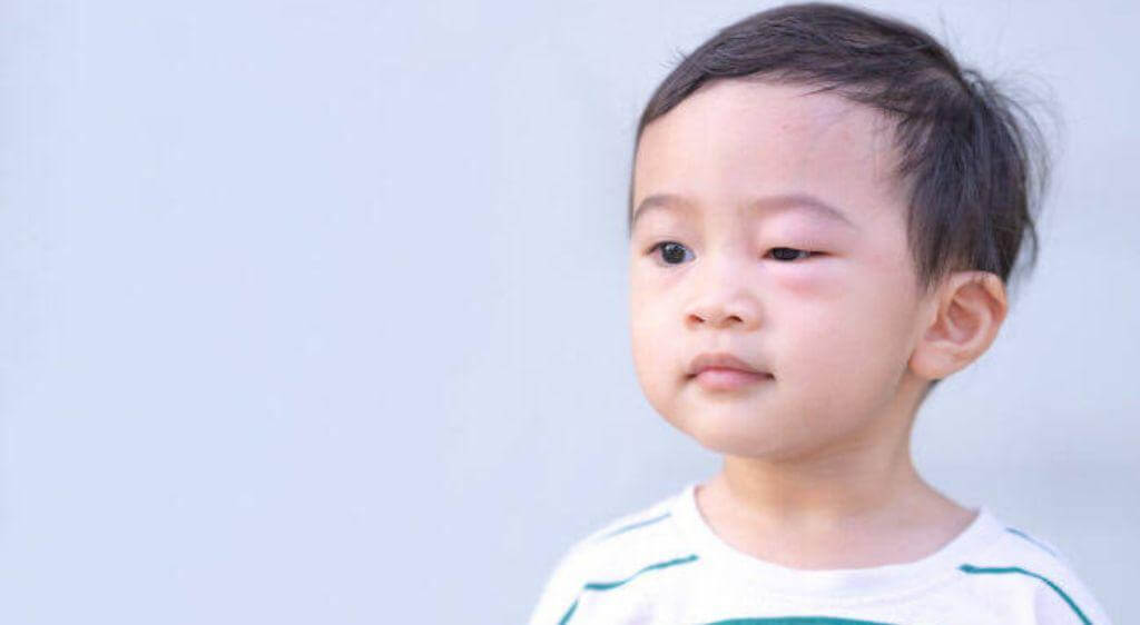 Trẻ bị sưng bọng mắt dưới có thể có nhiều nguyên nhân khác nhau như viêm kết mạc, chắp, lẹo, côn trùng đốt,...