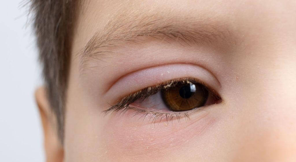 Trẻ bị sưng mắt có thể do côn trùng đốt, phản ứng dị ứng, chắp, lẹo,... gây ra