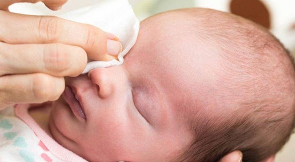 Vệ sinh mắt đúng cách giúp làm sạch ghèn và hạn chế lây nhiễm chéo.