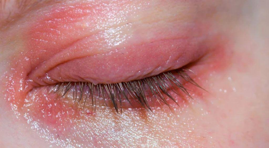 Viêm bờ mi do vi khuẩn là một trong những nguyên nhân khiến mắt nổi mụn nước