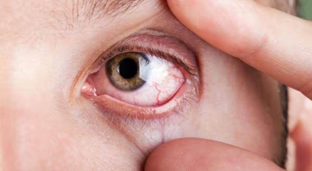 Viêm dây thần kinh thị giác thường chỉ xảy ra ở một mắt