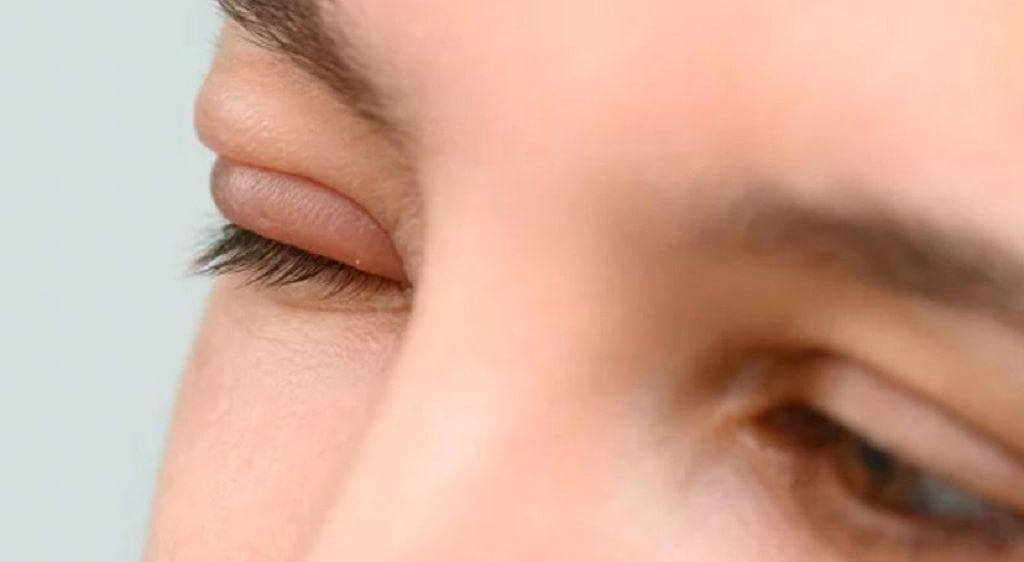 Vùng da quanh mắt bị sưng khiến mắt phù nề, căng rát hoặc hẹp khe mi bất thường