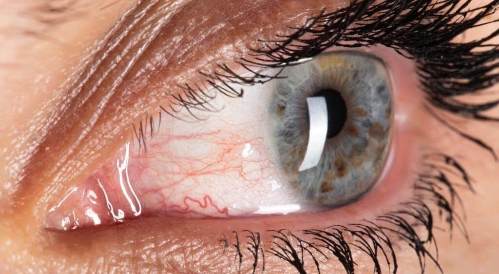 Xuất hiện nhiều mạch máu quanh tổn thương, cần thăm khám ngay