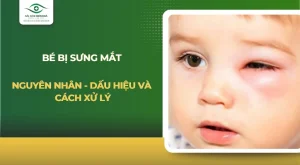 Bé bị sưng mắt