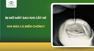 Bị mờ mắt sau khi cắt mí