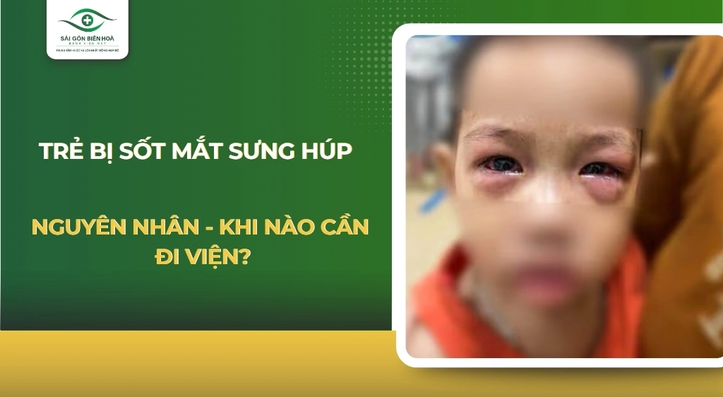 bị sốt mắt sưng húp