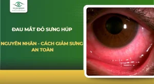 Đau mắt đỏ sưng húp