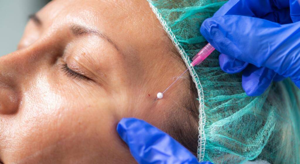 Filler hốc mắt phù hợp hơn với tình trạng hõm quanh mắt chủ yếu do thiếu thể tích mô mềm.