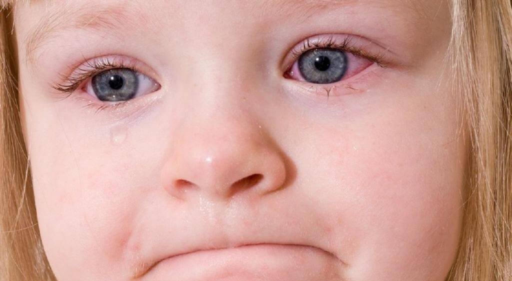 LHON là bệnh di truyền hiếm gặp gây tổn thương tế bào hạch võng mạc và dây thần kinh thị giác