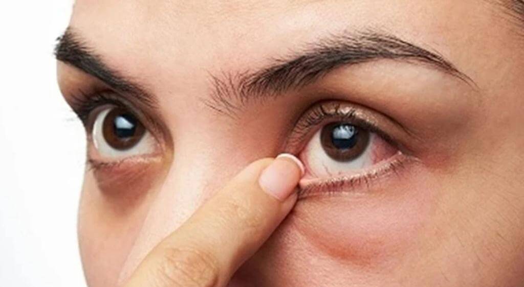 Mang biến thể gây LHON không đồng nghĩa chắc chắn sẽ xuất hiện giảm thị lực