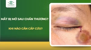 Mắt bị mờ sau chấn thương