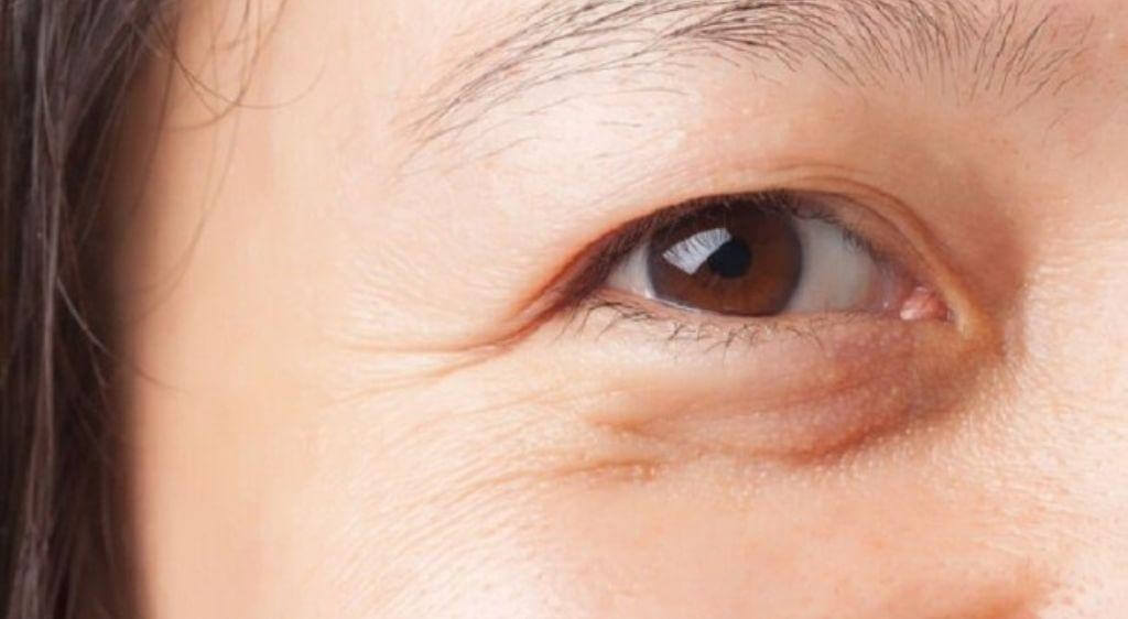 Mắt lõm thật sự xảy ra khi nhãn cầu nằm lùi ra sau trong khoang hốc mắt