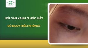 Nổi gân xanh ở hốc mắt
