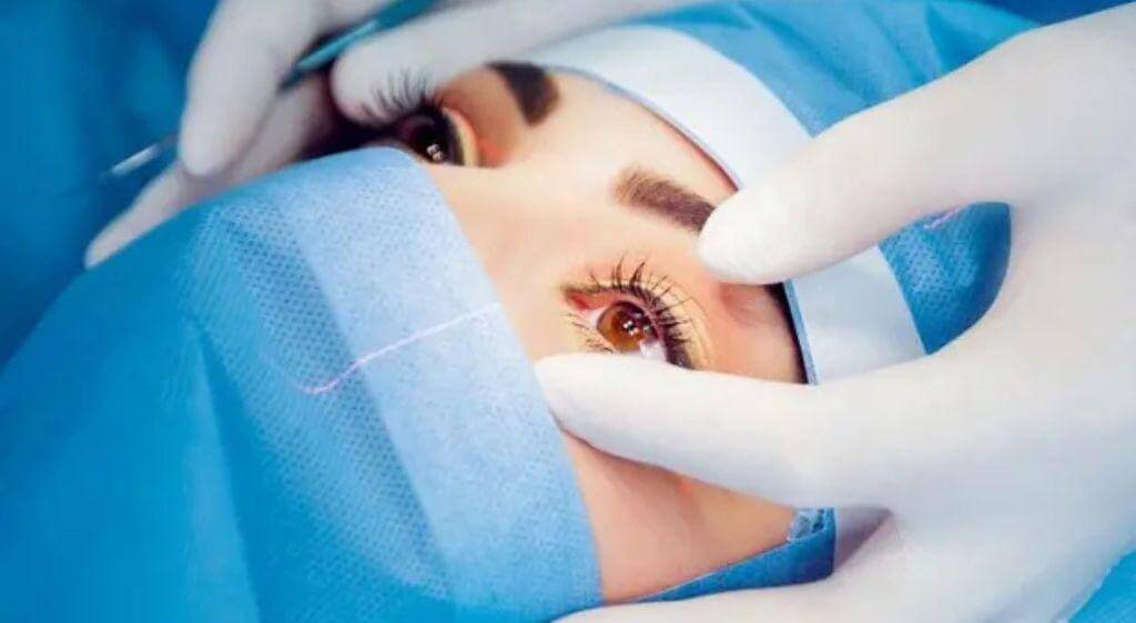 Quy trình TransPRK cho hai mắt thường kéo dài khoảng 10–15 phút, thời gian chiếu laser thay đổi theo độ khúc xạ và hệ thống thiết bị
