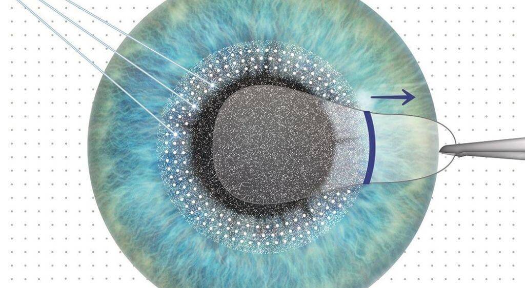 ReLEx SMILE sử dụng laser femtosecond tạo lõi mô trong nhu mô giác mạc và lấy lõi mô qua một đường rạch nhỏ.