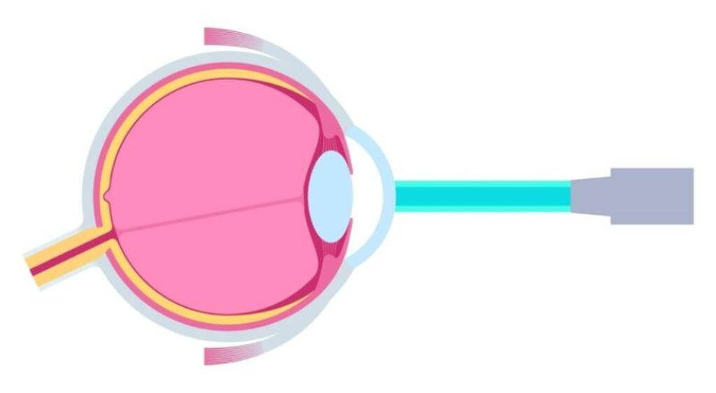 Tia Excimer Laser sẽ tạo ra năng lượng ở bước sóng 193nm, giúp gọt và tái định hình lại gác mạc