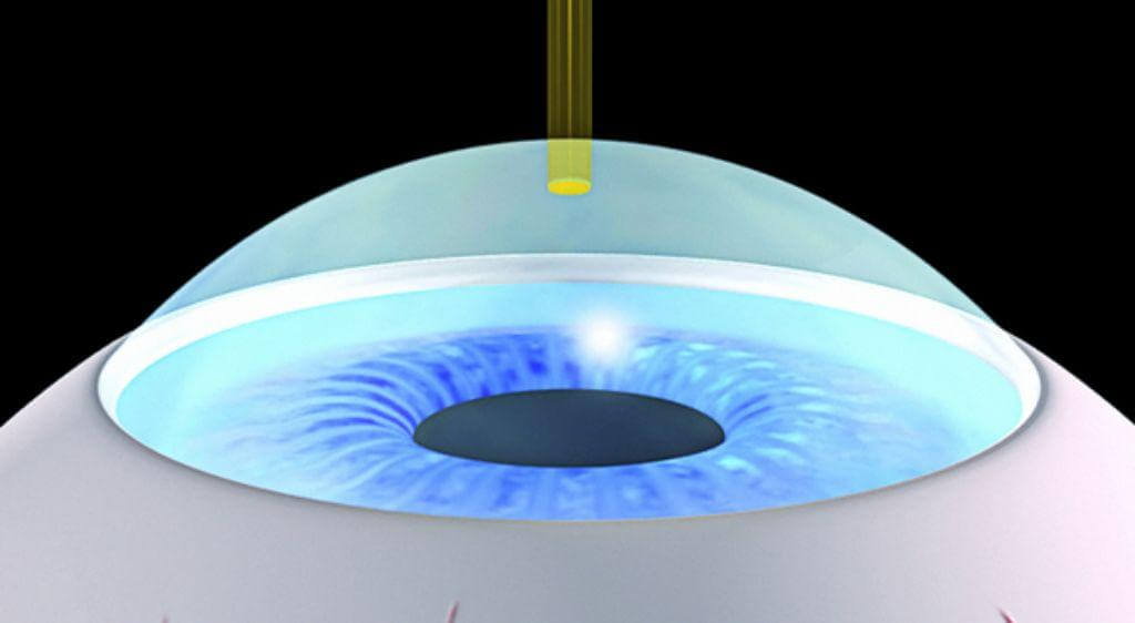TransPRK sử dụng laser Excimer để loại bỏ biểu mô và điều chỉnh độ cong giác mạc trong một quy trình liên tục