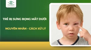 Trẻ bị sưng bọng mắt dưới