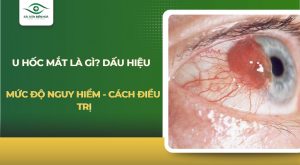U hốc mắt