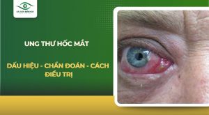 Ung thư hốc mắt