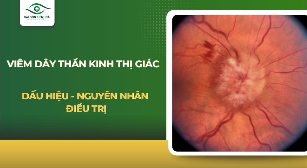 Viêm dây thần kinh thị giác