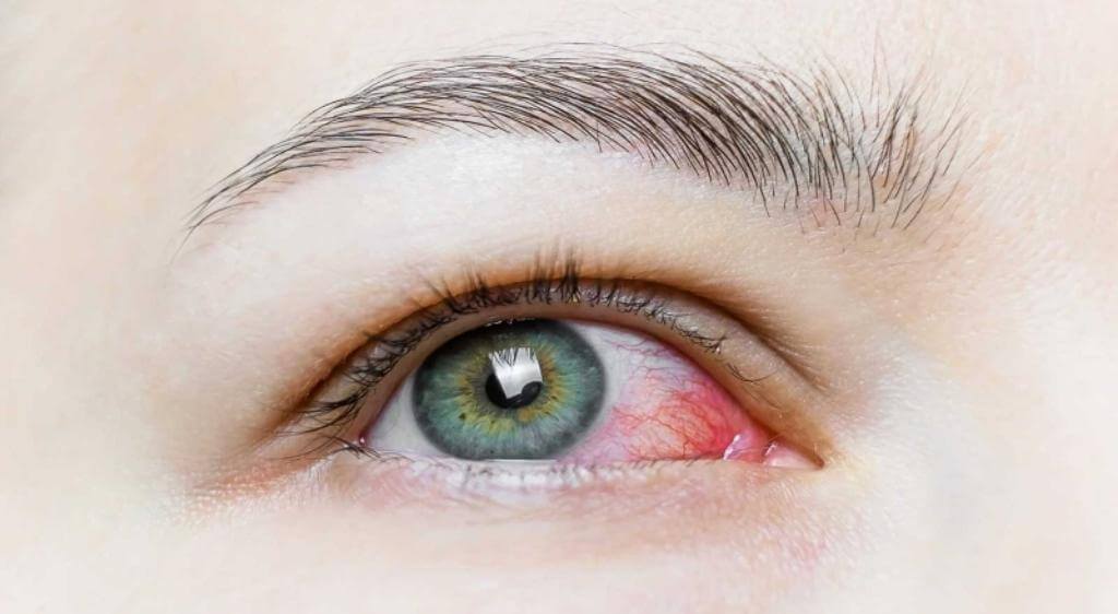 Viêm đĩa thị giác thường gây giảm thị lực đột ngột, đau khi cử động mắt