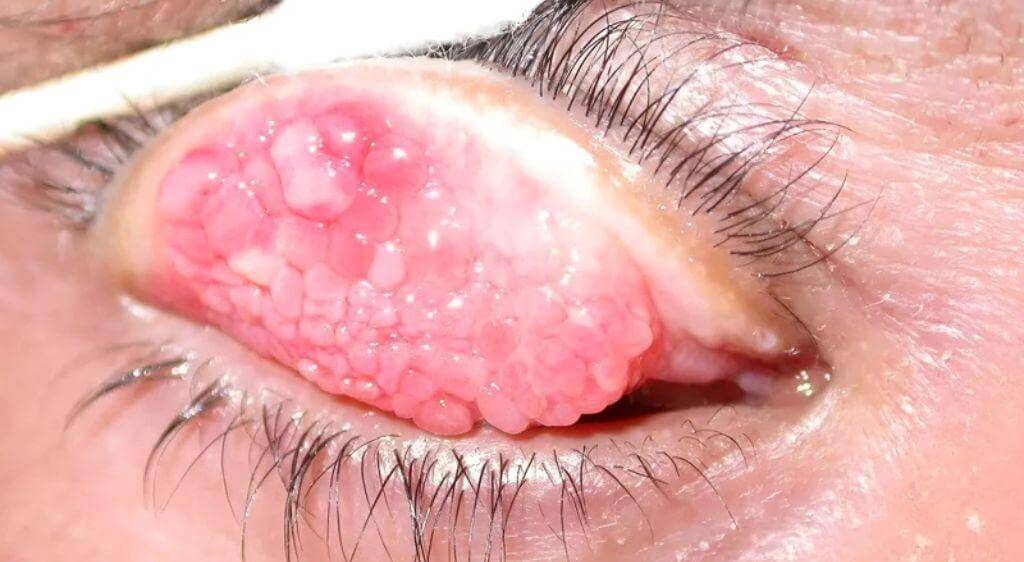 Viêm kết mạc mùa xuân là một thể viêm dị ứng thường bùng phát cấp tính ở mùa xuân hoặc mùa hè