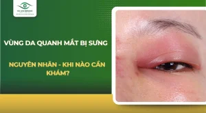Vùng da quanh mắt bị sưng