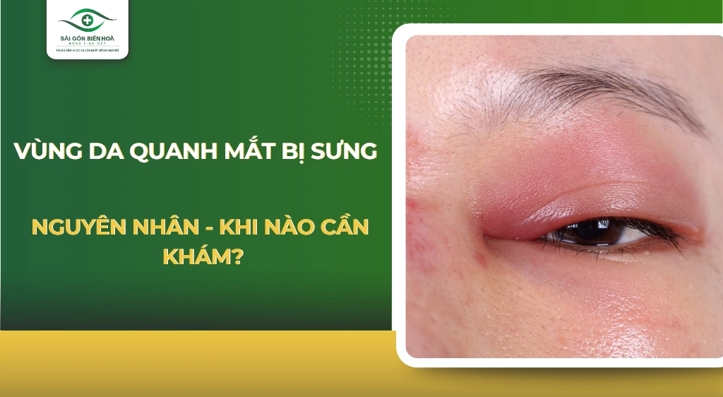 Vùng da quanh mắt bị sưng