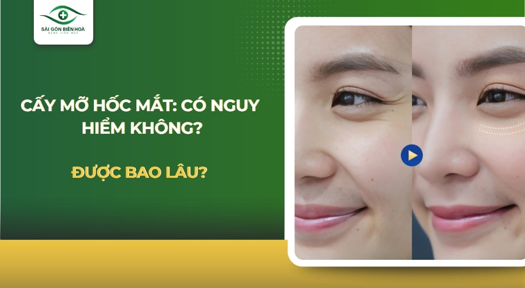 cấy mỡ hốc mắt