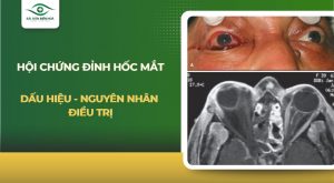 Hội chứng đỉnh hốc mắt