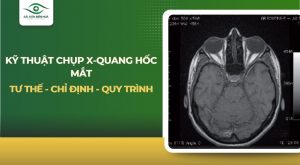 Kỹ thuật chụp X-quang hốc mắt