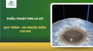 Phẫu thuật PRK