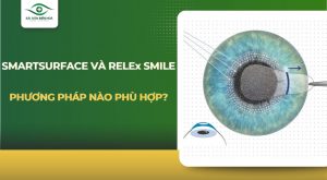 SmartSurfACE và ReLEx SMILE