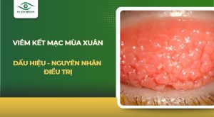 Viêm kết mạc mùa xuân