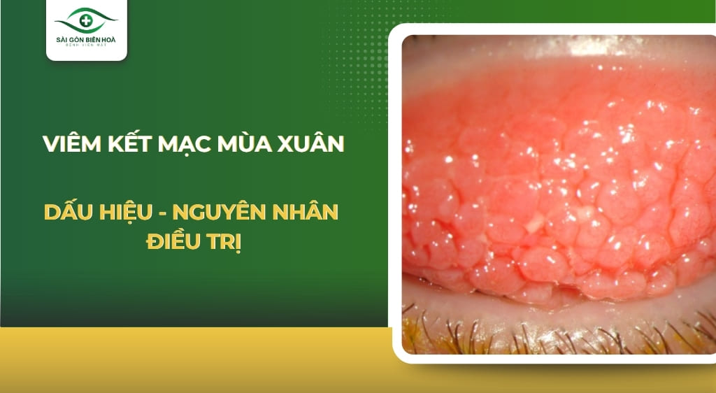 Viêm kết mạc mùa xuân